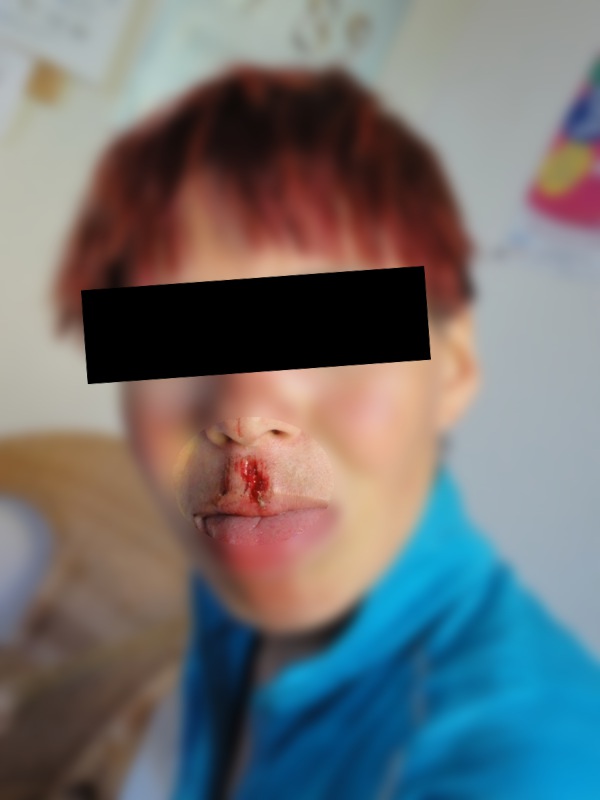 Die erste Gesichtsverletzung ohne Stützredli; Unkenntlich gemacht zum Persönlichkeitsschutz